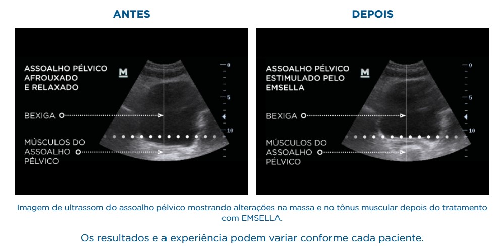 ANTES-E-DEPOIS-CADEIRA-EMSELLA