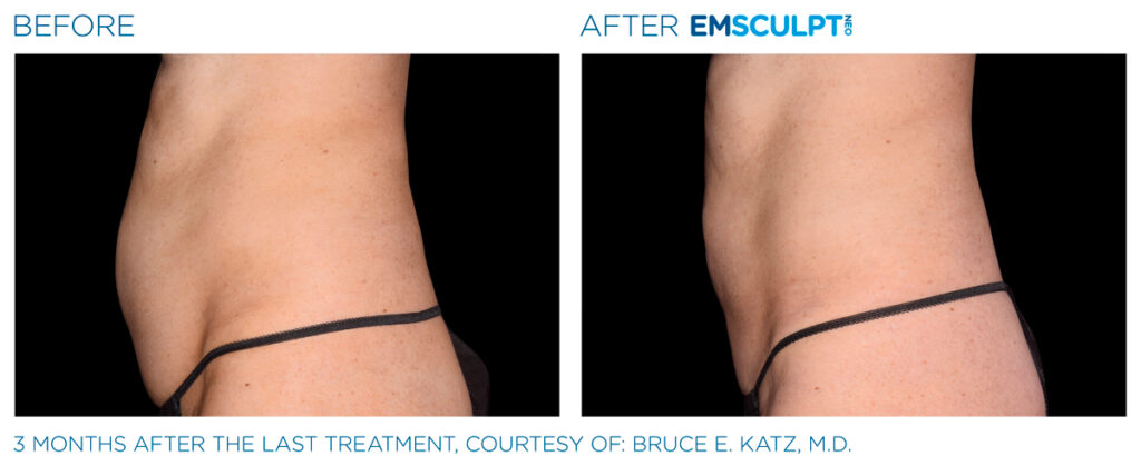 img-EMSCULPT NEO BTL-antes-e-depois-12
