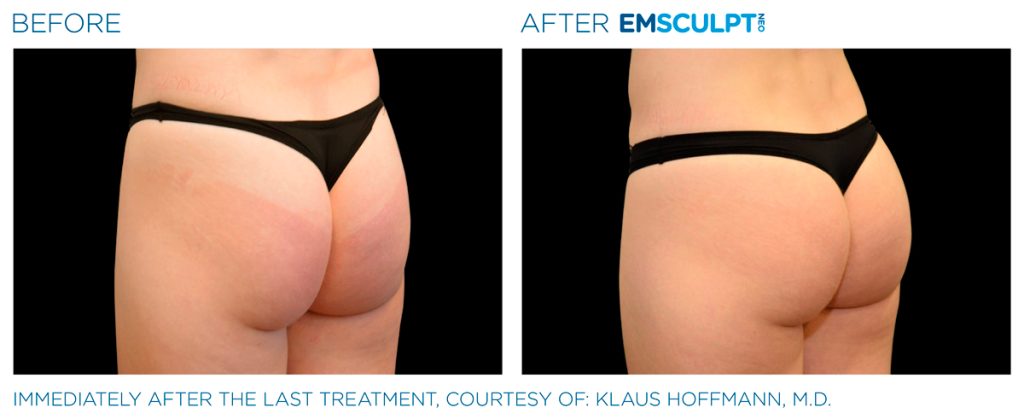 img-EMSCULPT NEO BTL-antes-e-depois-10