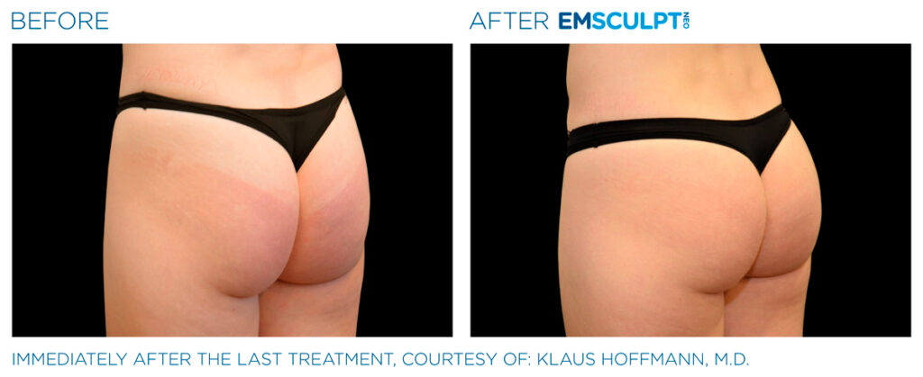 img-EMSCULPT NEO BTL-antes-e-depois-17