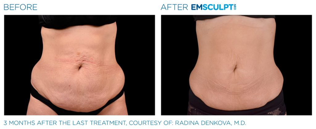img-EMSCULPT NEO BTL-antes-e-depois-11