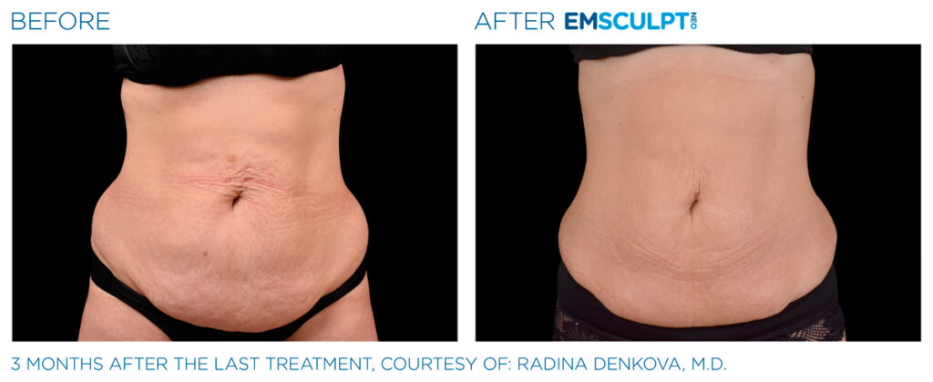 img-EMSCULPT NEO BTL-antes-e-depois-19