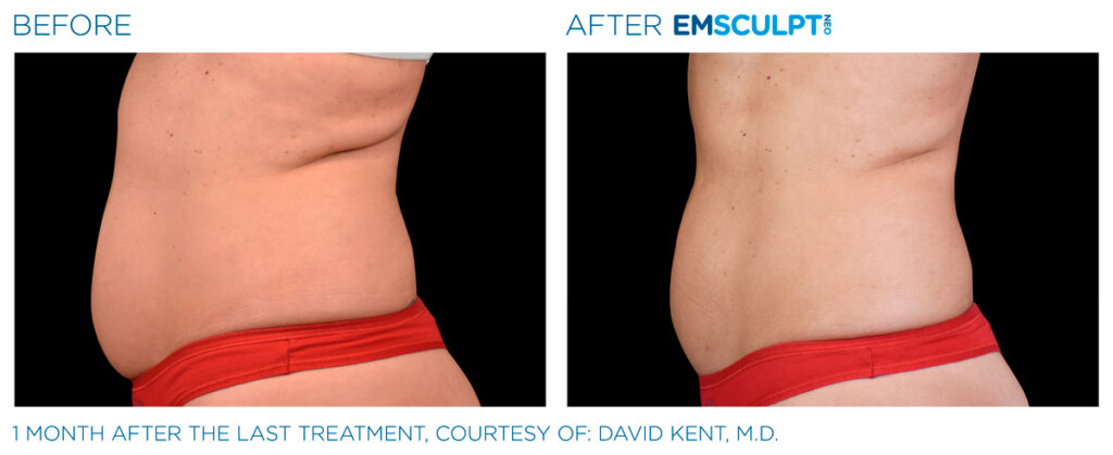 img-EMSCULPT NEO BTL-antes-e-depois-18
