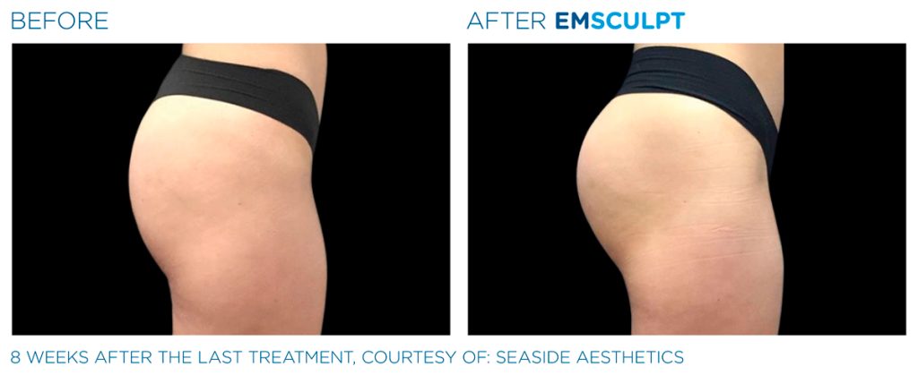 img-EMSCULPT NEO BTL-antes-e-depois-15