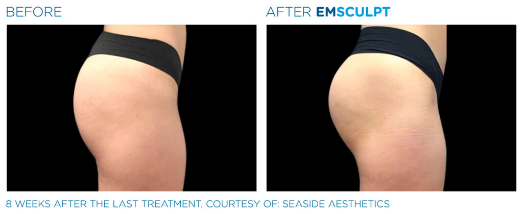 img-EMSCULPT NEO BTL-antes-e-depois-20