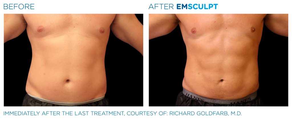 img-EMSCULPT NEO BTL-antes-e-depois-1