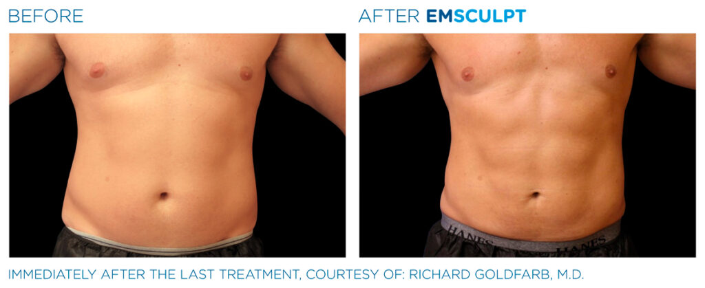 img-EMSCULPT NEO BTL-antes-e-depois-4