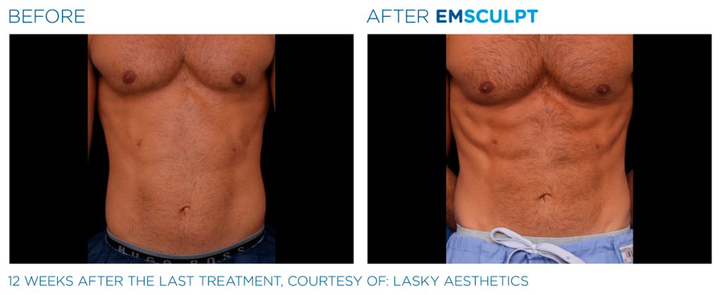 img-EMSCULPT NEO BTL-antes-e-depois-3
