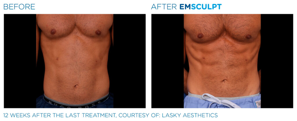 img-EMSCULPT NEO BTL-antes-e-depois-9