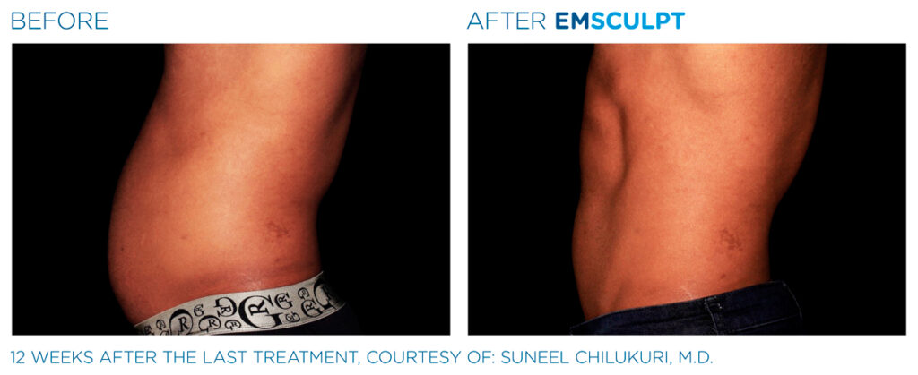 img-EMSCULPT NEO BTL-antes-e-depois-14