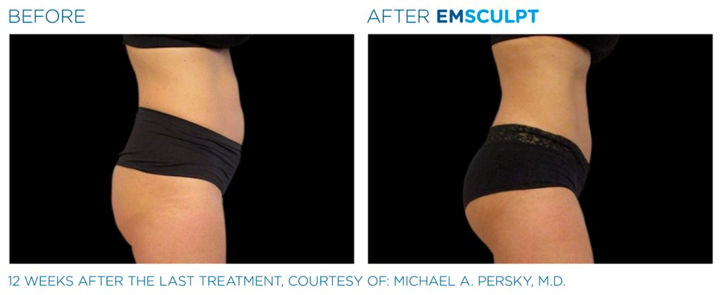 img-EMSCULPT NEO BTL-antes-e-depois-2