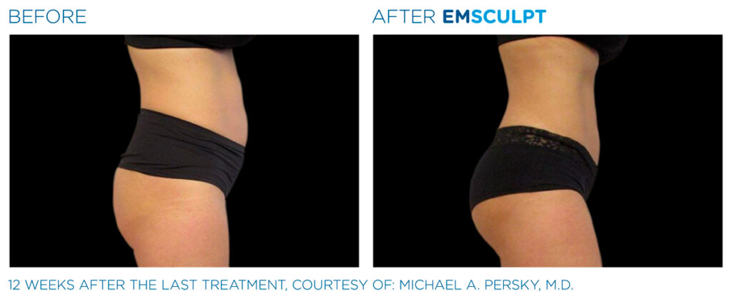 img-EMSCULPT NEO BTL-antes-e-depois-7