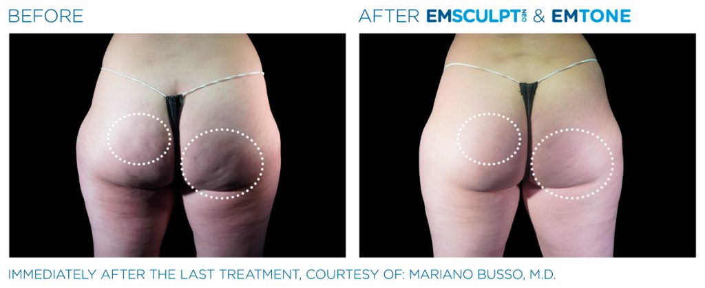 img-EMSCULPT NEO BTL-antes-e-depois-6