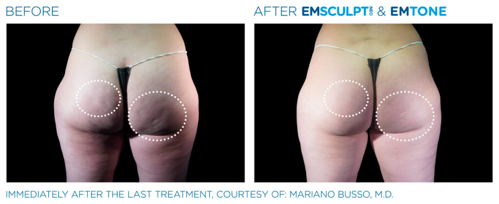 img-EMSCULPT NEO BTL-antes-e-depois-13