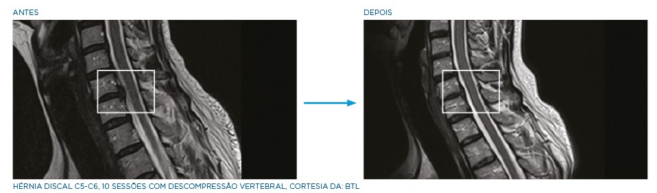 marquesa-de-descomrpessao-antes-e-depois-1